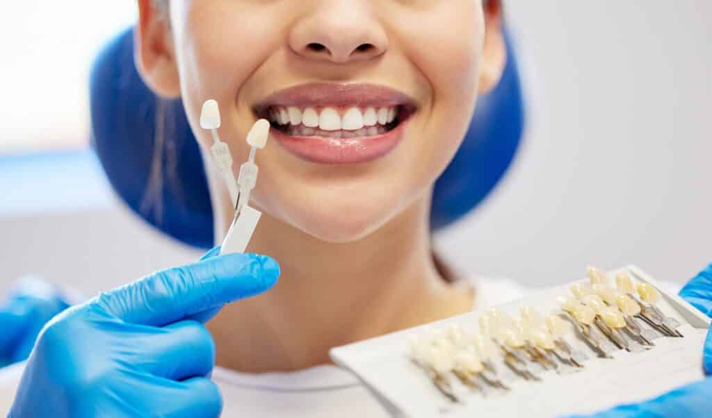 Dental Veneers in Granbury