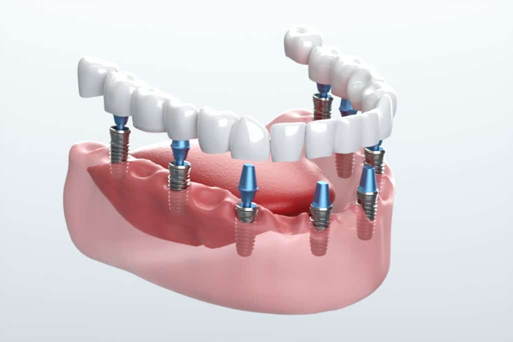 All-on-4 Dental Implants Granbury