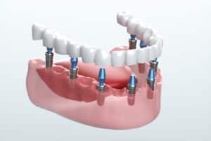 All-on-4 Dental Implants Granbury