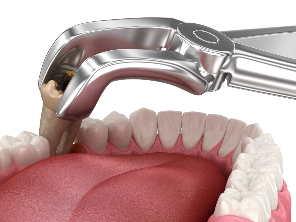 Wisdom Teeth Removal Granbury