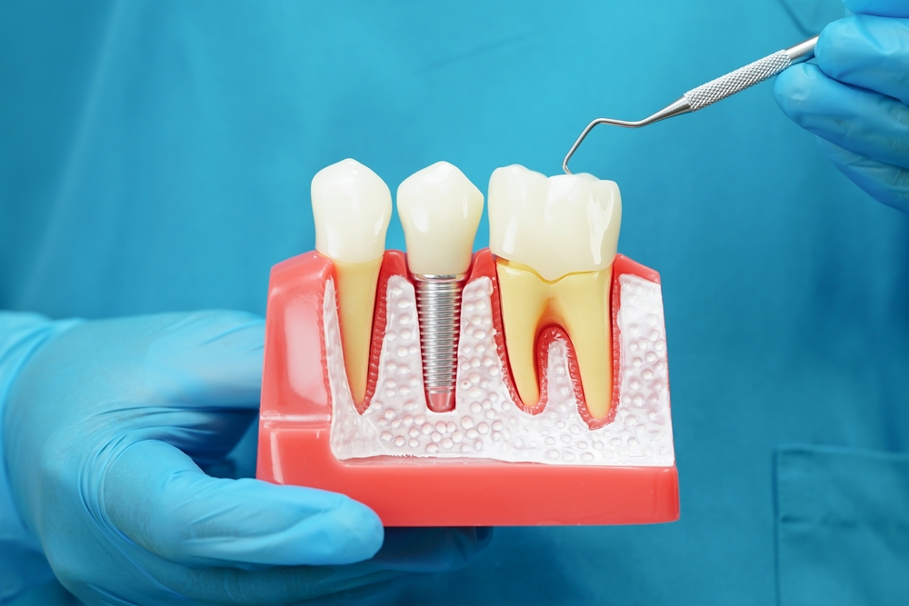 Dental Implants Granbury